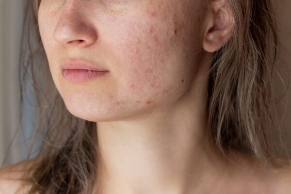 Coșuri pe bărbie: de ce apar și cum le poți preveni